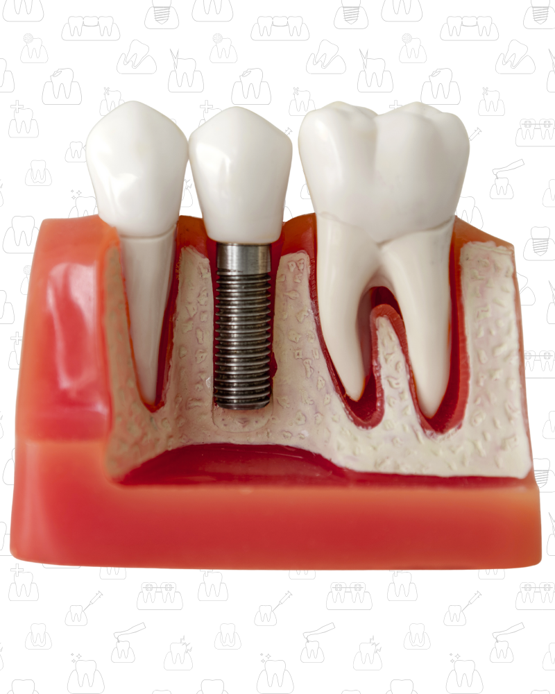 Dental Implant clinic near me in Vijayawada