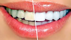 Teeth whitening cost in Vijayawada