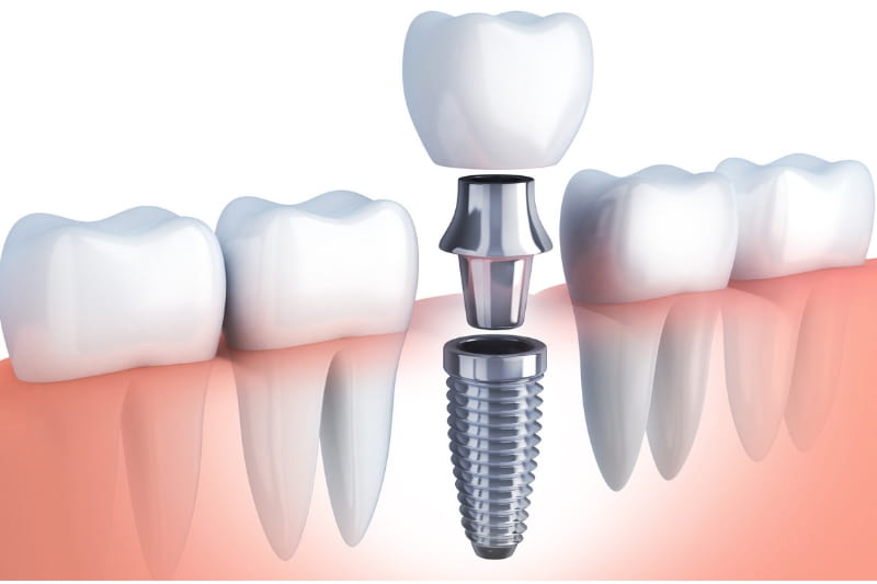 Best Dental hospital for dental implants in vijayawada