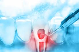 Best Laser Root Canal Treatment in Vijayawada