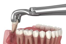 Painless Wisdom tooth extraction in Vijayawada