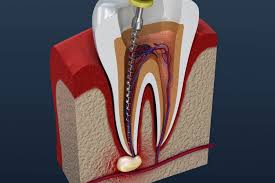 Best Dental hospital for root canal treatment in Vijayawada