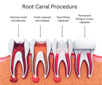 Best dental clinic for root canal treatment in Vijayawada