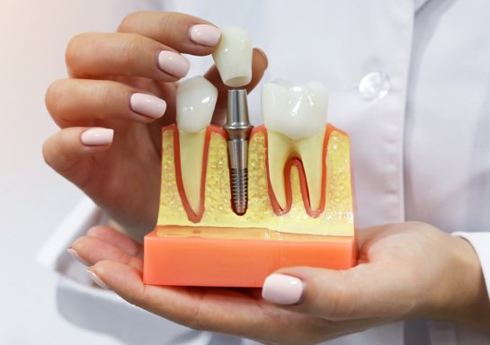 Dental Implant surgery in Vijayawada