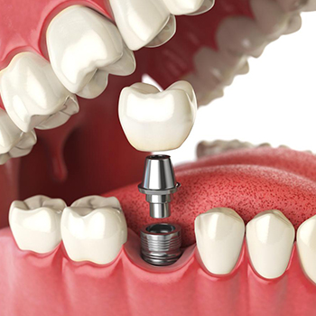 Dental Implants dentistry near me