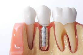 Best dental clinic in Vijayawada for dental Implants