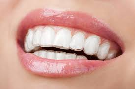 Invisalign dentistry in Vijayawada