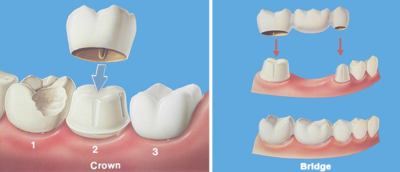 Dental crowns and bridges doctors in Vijayawada