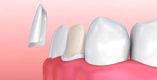 Best Dental Hospital For dental veneers in Vijayawada