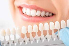 Dental Veneers doctors in Vijayawada