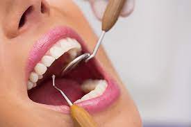 Teeth Scaling Near me 