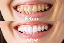 Teeth scaling clinic in Vijayawada