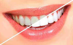 Best Teeth whitening clinic near me