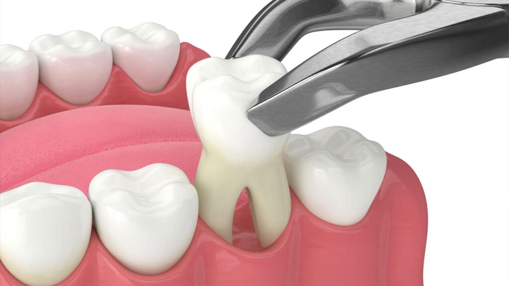 Best Dental Clinic for tooth extraction in Vijayawada
