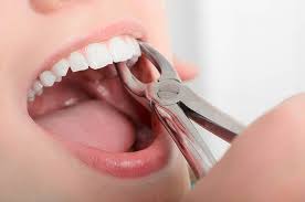 Teeth Extractions near me in Vijayawada