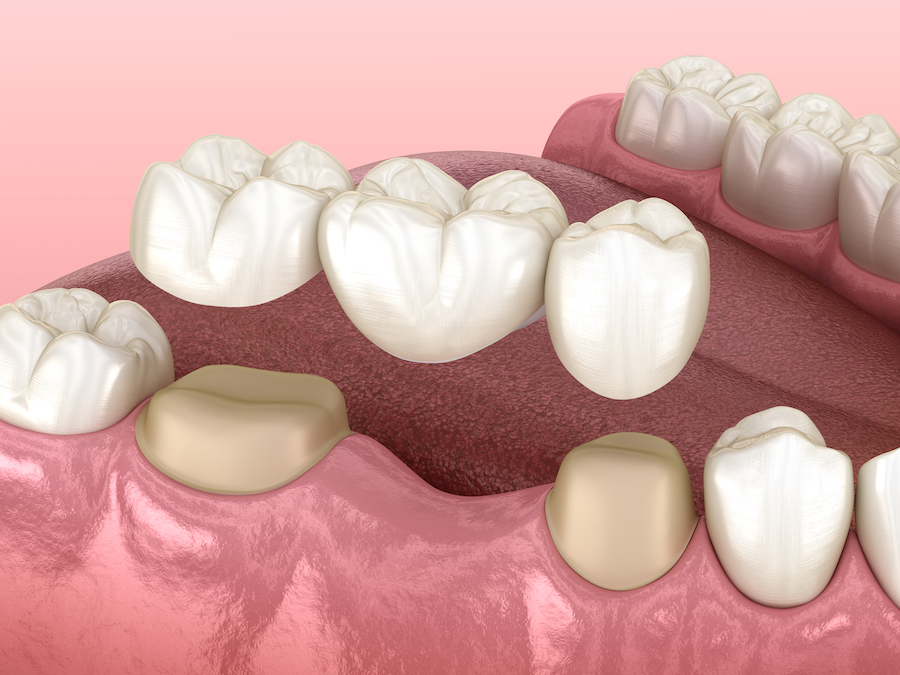 best dental clinic for Dental crowns and bridges in Vijayawada
