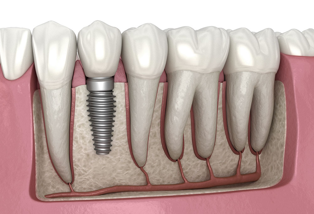 Affordable dental implant packages in Vijayawada