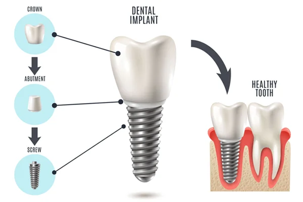 Reviews of Dental Implant services in Vijayawada