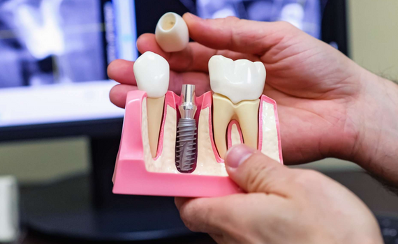 Are there any dental implant financing options in Vijayawada