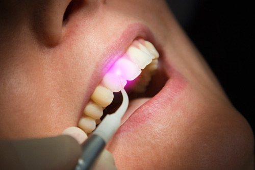 is dental laser safe during pregnancy
