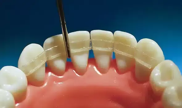 Orthodontic treatment in Vijayawada