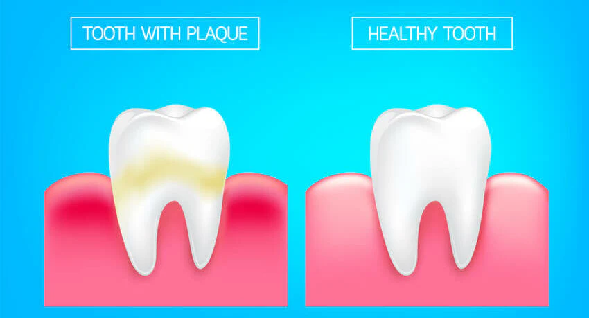 causes, prevention, treatment, removal of dental plaque