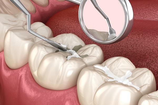 Dental sealants treatment near me in Vijayawada