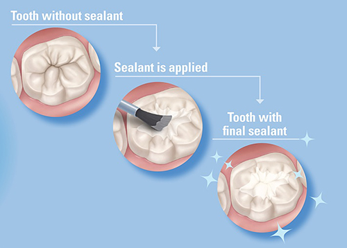 Best Dental Sealants Treatment in Vijayawada