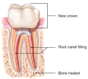 Best Dental Clinic For Re-Root Canal Treatment in Vijayawada