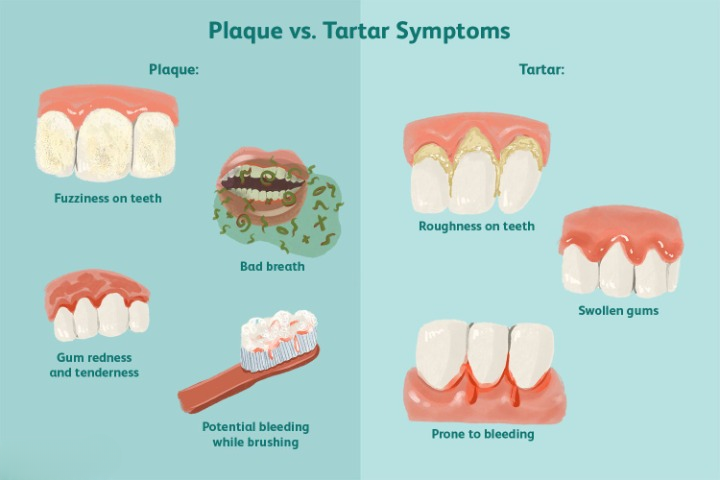 How to remove dental plaque
