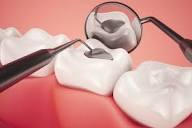 Dental Fillings Treatment in Vijayawada