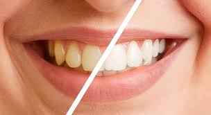 Teeth polishing in Vijayawada