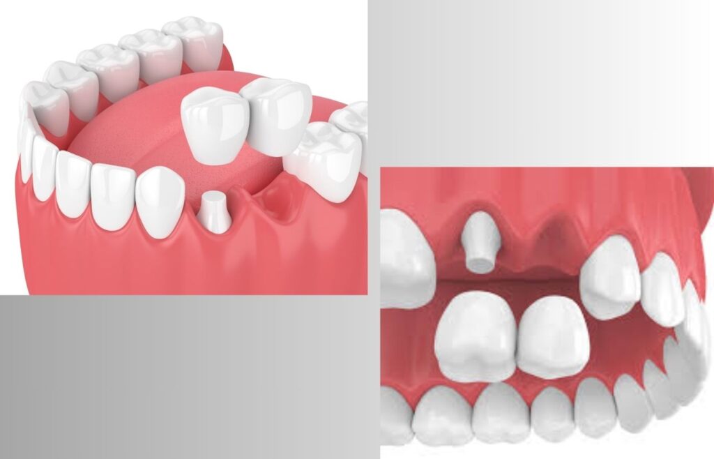 Cantilever dental bridge