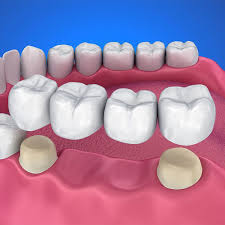 Dental bridge cost in Vijayawada