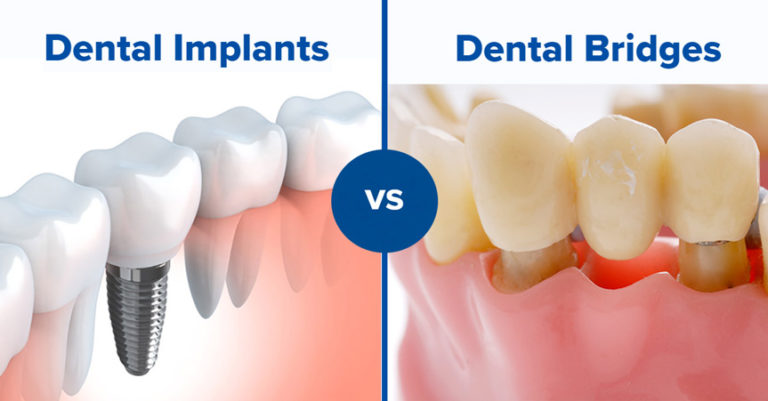 Which is better: Dental Implants vs. bridges?