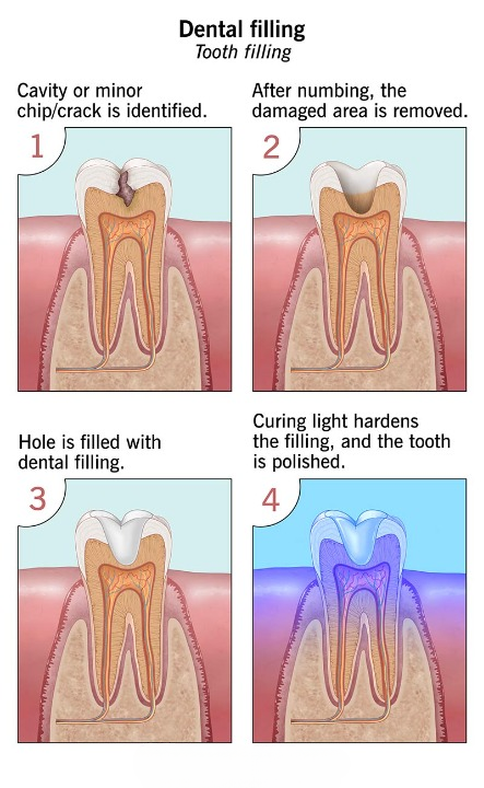 Best dental hospital for dental fillings in Vijayawada
