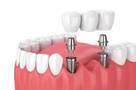 Implant supported dental bridge